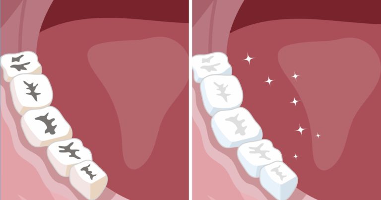 Care sunt cele 8 moduri prin care vă puteți menține dinții curați și sănătoși?