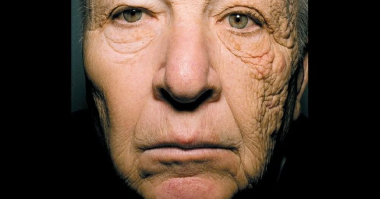 Un bărbat de 69 de ani și-a distrus partea stângă a feței fiind șofer de camion timp de 28 de ani