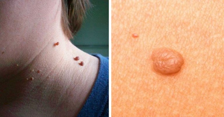 9 metode efective de a scapă de semnele de naştere.Folosiți-le cu încredere!